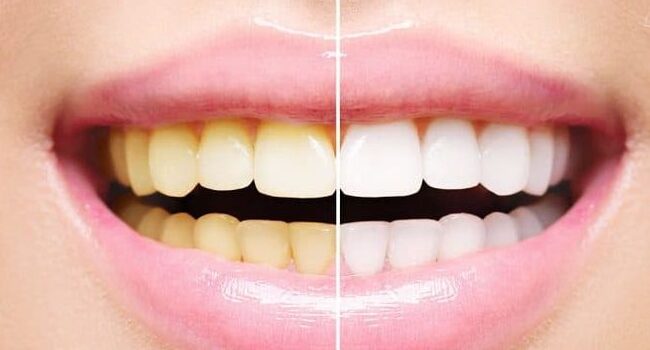 Bright, healthy teeth before and after whitening treatment.